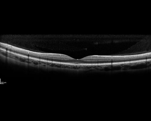Multifocal Choroiditis - Pneumocystis - aspergillis - cryptococcus
31 year old male with anaplastic astrocytoma on chemotherapy with mild vision loss in the right eye.  LP did not reveal organism.  He was placed on a trial of anti-fungal medications and lost to follow-up
