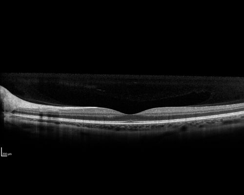 Multifocal Choroiditis - Pneumocystis - aspergillis - cryptococcus
31 year old male with anaplastic astrocytoma on chemotherapy with mild vision loss in the right eye.  LP did not reveal organism.  He was placed on a trial of anti-fungal medications and lost to follow-up
