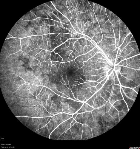 Multifocal Choroiditis - Pneumocystis - aspergillis - cryptococcus
31 year old male with anaplastic astrocytoma on chemotherapy with mild vision loss in the right eye.  LP did not reveal organism.  He was placed on a trial of anti-fungal medications and lost to follow-up

