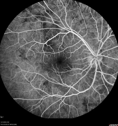 Multifocal Choroiditis - Pneumocystis - aspergillis - cryptococcus
31 year old male with anaplastic astrocytoma on chemotherapy with mild vision loss in the right eye.  LP did not reveal organism.  He was placed on a trial of anti-fungal medications and lost to follow-up
