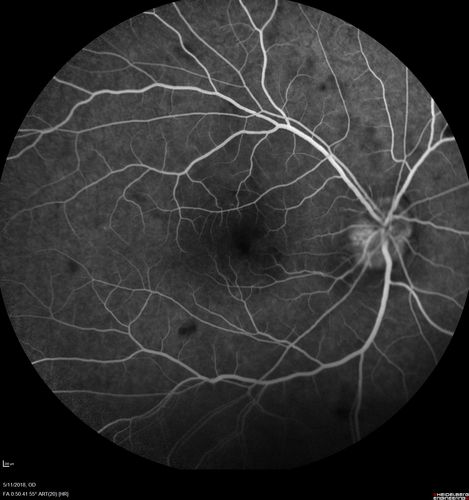 Multifocal Choroiditis - Pneumocystis - aspergillis - cryptococcus
31 year old male with anaplastic astrocytoma on chemotherapy with mild vision loss in the right eye.  LP did not reveal organism.  He was placed on a trial of anti-fungal medications and lost to follow-up

