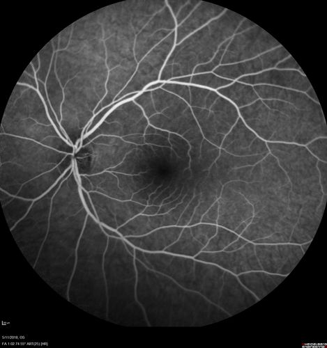 Multifocal Choroiditis - Pneumocystis - aspergillis - cryptococcus
31 year old male with anaplastic astrocytoma on chemotherapy with mild vision loss in the right eye.  LP did not reveal organism.  He was placed on a trial of anti-fungal medications and lost to follow-up
