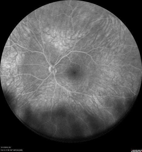 Multifocal Choroiditis - Pneumocystis - aspergillis - cryptococcus
31 year old male with anaplastic astrocytoma on chemotherapy with mild vision loss in the right eye.  LP did not reveal organism.  He was placed on a trial of anti-fungal medications and lost to follow-up

