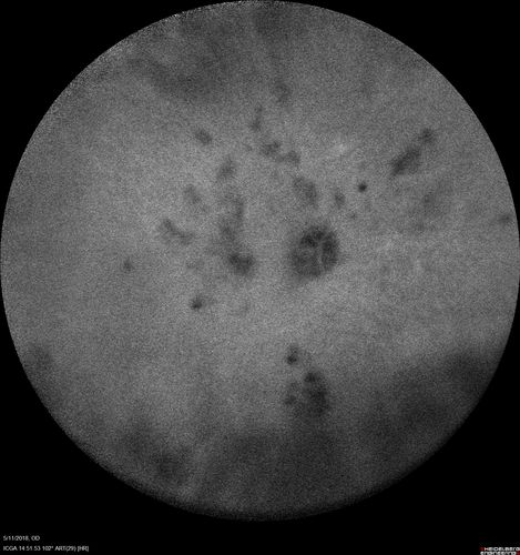 Multifocal Choroiditis - Pneumocystis - aspergillis - cryptococcus
31 year old male with anaplastic astrocytoma on chemotherapy with mild vision loss in the right eye.  LP did not reveal organism.  He was placed on a trial of anti-fungal medications and lost to follow-up
