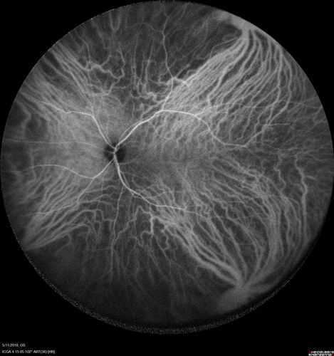 Multifocal Choroiditis - Pneumocystis - aspergillis - cryptococcus
31 year old male with anaplastic astrocytoma on chemotherapy with mild vision loss in the right eye.  LP did not reveal organism.  He was placed on a trial of anti-fungal medications and lost to follow-up
