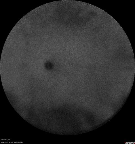 Multifocal Choroiditis - Pneumocystis - aspergillis - cryptococcus
31 year old male with anaplastic astrocytoma on chemotherapy with mild vision loss in the right eye.  LP did not reveal organism.  He was placed on a trial of anti-fungal medications and lost to follow-up
