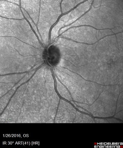 Multifocal Choroiditis Panuveitis with Subretinal Fibrosis Acute Phase
36 year old latin american female 3 weeks of vision loss and new headaches.  MRI was normal.  VA initially 20/32 OD; 20/20 OS Final vision was 20/63 OD; 20/20 OS
