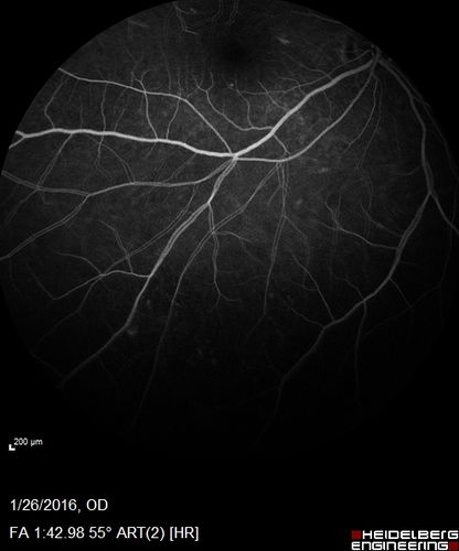 Multifocal Choroiditis Panuveitis with Subretinal Fibrosis Acute Phase
36 year old latin american female 3 weeks of vision loss and new headaches.  MRI was normal.  VA initially 20/32 OD; 20/20 OS Final vision was 20/63 OD; 20/20 OS
