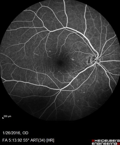 Multifocal Choroiditis Panuveitis with Subretinal Fibrosis Acute Phase
36 year old latin american female 3 weeks of vision loss and new headaches.  MRI was normal.  VA initially 20/32 OD; 20/20 OS Final vision was 20/63 OD; 20/20 OS
