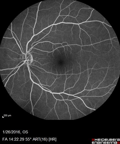 Multifocal Choroiditis Panuveitis with Subretinal Fibrosis Acute Phase
36 year old latin american female 3 weeks of vision loss and new headaches.  MRI was normal.  VA initially 20/32 OD; 20/20 OS Final vision was 20/63 OD; 20/20 OS

