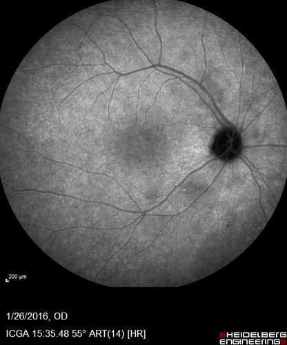 Multifocal Choroiditis Panuveitis with Subretinal Fibrosis Acute Phase
36 year old latin american female 3 weeks of vision loss and new headaches.  MRI was normal.  VA initially 20/32 OD; 20/20 OS Final vision was 20/63 OD; 20/20 OS
