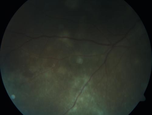 Multifocal Choroiditis Panuveitis with Subretinal Fibrosis Acute Phase
36 year old latin american female 3 weeks of vision loss and new headaches.  MRI was normal.  VA initially 20/32 OD; 20/20 OS Final vision was 20/63 OD; 20/20 OS
