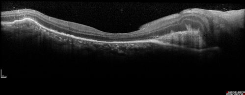 Multifocal Choroiditis Panuveitis with Subretinal Fibrosis Acute Phase
36 year old latin american female 3 weeks of vision loss and new headaches.  MRI was normal.  VA initially 20/32 OD; 20/20 OS Final vision was 20/63 OD; 20/20 OS
