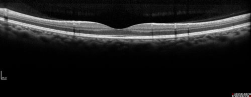 Multifocal Choroiditis Panuveitis with Subretinal Fibrosis Acute Phase
36 year old latin american female 3 weeks of vision loss and new headaches.  MRI was normal.  VA initially 20/32 OD; 20/20 OS Final vision was 20/63 OD; 20/20 OS
