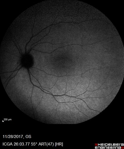 Multifocal Choroiditis Panuveitis with Subretinal Fibrosis Acute Phase
36 year old latin american female 3 weeks of vision loss and new headaches.  MRI was normal.  VA initially 20/32 OD; 20/20 OS Final vision was 20/63 OD; 20/20 OS
