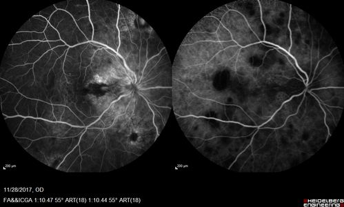 Multifocal Choroiditis Panuveitis with Subretinal Fibrosis Acute Phase
36 year old latin american female 3 weeks of vision loss and new headaches.  MRI was normal.  VA initially 20/32 OD; 20/20 OS Final vision was 20/63 OD; 20/20 OS
