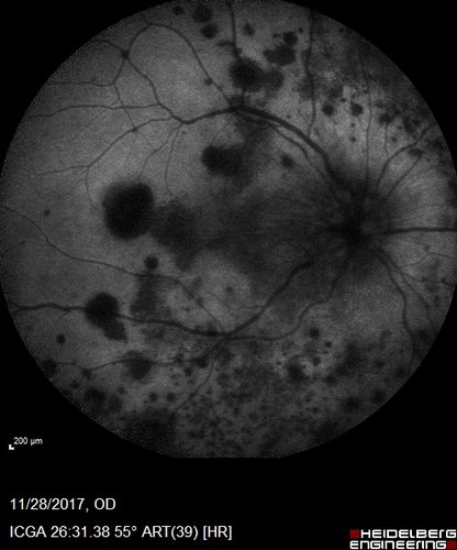 Multifocal Choroiditis Panuveitis with Subretinal Fibrosis Acute Phase
36 year old latin american female 3 weeks of vision loss and new headaches.  MRI was normal.  VA initially 20/32 OD; 20/20 OS Final vision was 20/63 OD; 20/20 OS
