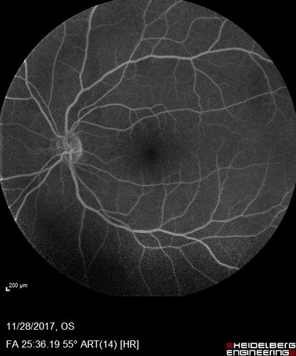 Multifocal Choroiditis Panuveitis with Subretinal Fibrosis Acute Phase
36 year old latin american female 3 weeks of vision loss and new headaches.  MRI was normal.  VA initially 20/32 OD; 20/20 OS Final vision was 20/63 OD; 20/20 OS
