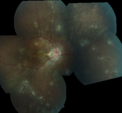 Multifocal Choroiditis Panuveitis with Subretinal Fibrosis Acute Phase
36 year old latin american female 3 weeks of vision loss and new headaches.  MRI was normal.  VA initially 20/32 OD; 20/20 OS Final vision was 20/63 OD; 20/20 OS
