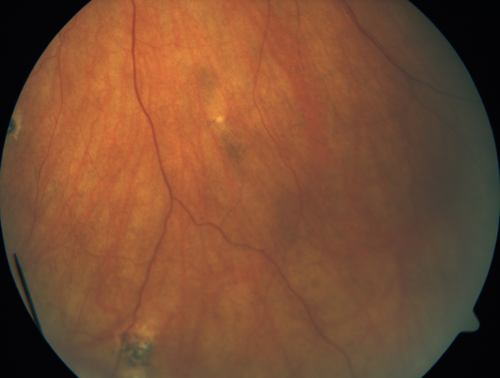 Multifocal Choroiditis - Linear Scars - Schlaegel lines
66 year old woman with macular pucker right eye.  Images show typical linear peripheral scars for MFC or POHS - this is unilateral.
