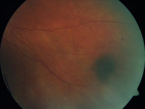 Multifocal Choroiditis - Linear Scars - Schlaegel lines
66 year old woman with macular pucker right eye.  Images show typical linear peripheral scars for MFC or POHS - this is unilateral.
