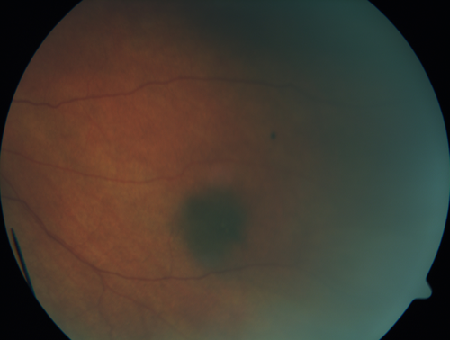 Multifocal Choroiditis - Linear Scars - Schlaegel lines
66 year old woman with macular pucker right eye.  Images show typical linear peripheral scars for MFC or POHS - this is unilateral.
