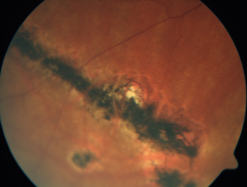 Multifocal Choroiditis - Linear Scars - Schlaegel lines
66 year old woman with macular pucker right eye.  Images show typical linear peripheral scars for MFC or POHS - this is unilateral.
