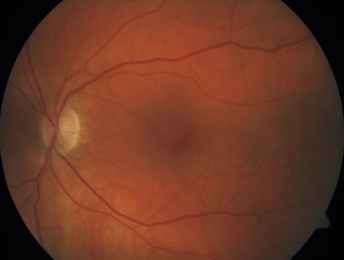 Multifocal Choroiditis - Linear Scars - Schlaegel lines
66 year old woman with macular pucker right eye.  Images show typical linear peripheral scars for MFC or POHS - this is unilateral.

