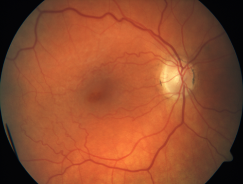 Multifocal Choroiditis - Linear Scars - Schlaegel lines
66 year old woman with macular pucker right eye.  Images show typical linear peripheral scars for MFC or POHS - this is unilateral.

