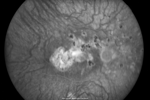 Multifocal Choroiditis and Subretinal Fibrosis - 32 yo Female FA Old Scar OS
32-year-old woman vision loss in the right eye associated with macular scarring and multifocal choroiditis in 1999 with new vision loss in left eye:  OD 20/400, OS 20/50. 
Keywords: Multifocal Choroiditis;Macular Scar;Fibrosis;Uveitis