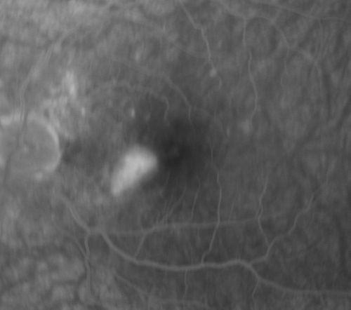 Multifocal Choroiditis and Subretinal Fibrosis - 32 yo Female New Lesion OS
32-year-old woman vision loss in the right eye associated with macular scarring and multifocal choroiditis in 1999 with new vision loss in left eye:  OD 20/400, OS 20/50. 
Keywords: Multifocal Choroiditis; Macular Scar; Fibrosis; Uveitis