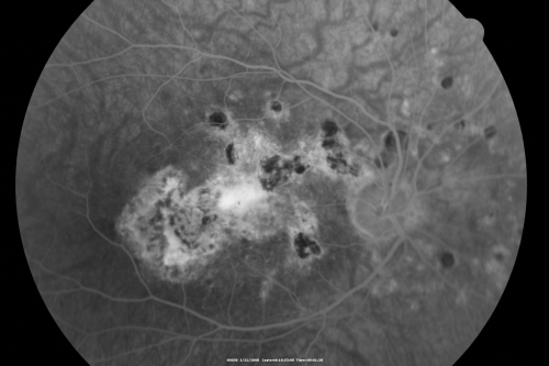 Multifocal Choroiditis and Subretinal Fibrosis - 32 yo Female Old Scar OD
32-year-old woman vision loss in the right eye associated with macular scarring and multifocal choroiditis in 1999 with new vision loss in left eye:  OD 20/400, OS 20/50. 
Keywords: Multifocal Choroiditis;Macular Scar;Fibrosis;Uveitis