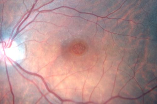 Macular Hole - Stage 4
53-year-old woman was seen in the office on 5/20/2011.  She had cataract surgery in June of 2009.  She noticed the vision in the left eye was starting to get foggy some time around the middle of April (1 month ago).

VISUAL ACUITY:  Vision OD is 20/20, OS is 20/160
