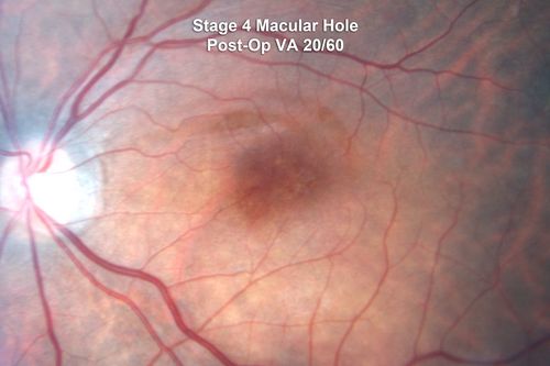 Macular Hole Closed - Nerve Fiber Layer Defects Visible after Internal Limiting Membrane Peel - Vision 20/60
53-year-old woman had vitrectomy for a stage IV macular hole in the left eye on June 1st.  Her vision has improved some but still has a bump in it.

VISUAL ACUITY:  Vision OS is 20/80, PH is 20/60
