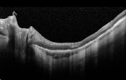 Retinal Pigment Epithleium Dysgenesis - SD OCT line Scan

