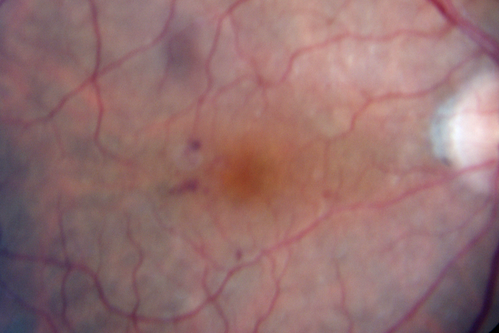 Microaneursyms and Macular Edema Not Diabetic
85 year old man has been tested about 2-3 times and is always negative for diabetes

