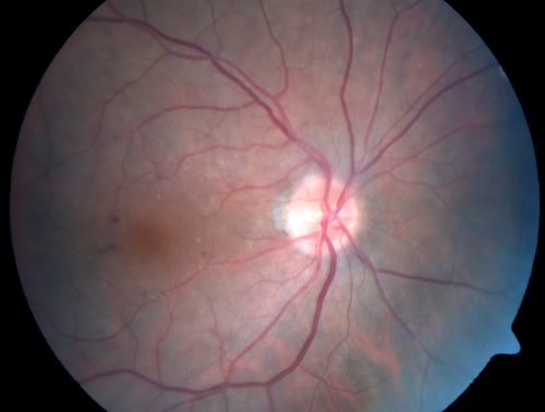 Microaneursyms and Macular Edema Not Diabetic
85 year old man has been tested about 2-3 times and is always negative for diabetes
