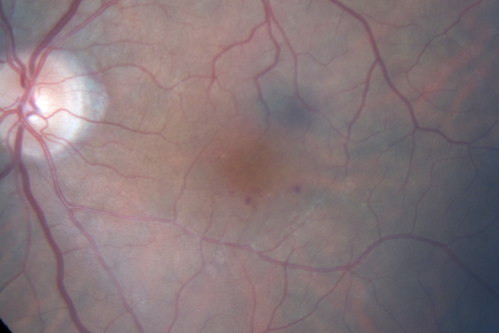 Microaneursyms and Macular Edema Not Diabetic
85 year old man has been tested about 2-3 times and is always negative for diabetes
