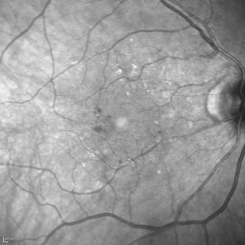 Microaneursyms and Macular Edema Not Diabetic
85 year old man has been tested about 2-3 times and is always negative for diabetes
