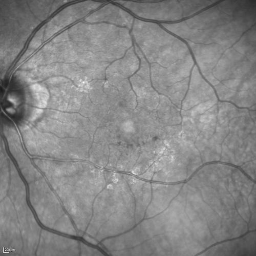 Microaneursyms and Macular Edema Not Diabetic
85 year old man has been tested about 2-3 times and is always negative for diabetes
