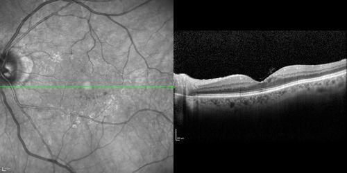 Microaneursyms and Macular Edema Not Diabetic
85 year old man has been tested about 2-3 times and is always negative for diabetes
