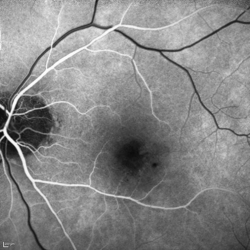 Microaneursyms and Macular Edema Not Diabetic
85 year old man has been tested about 2-3 times and is always negative for diabetes

