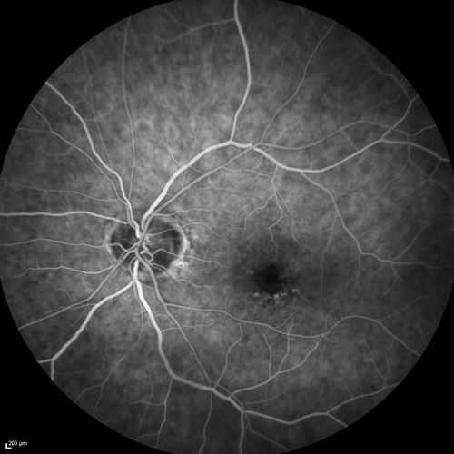 Microaneursyms and Macular Edema Not Diabetic
85 year old man has been tested about 2-3 times and is always negative for diabetes
