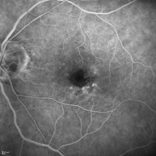 Microaneursyms and Macular Edema Not Diabetic
85 year old man has been tested about 2-3 times and is always negative for diabetes
