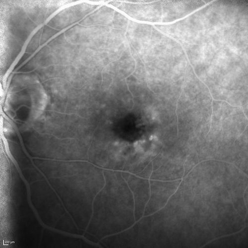 Microaneursyms and Macular Edema Not Diabetic
85 year old man has been tested about 2-3 times and is always negative for diabetes
