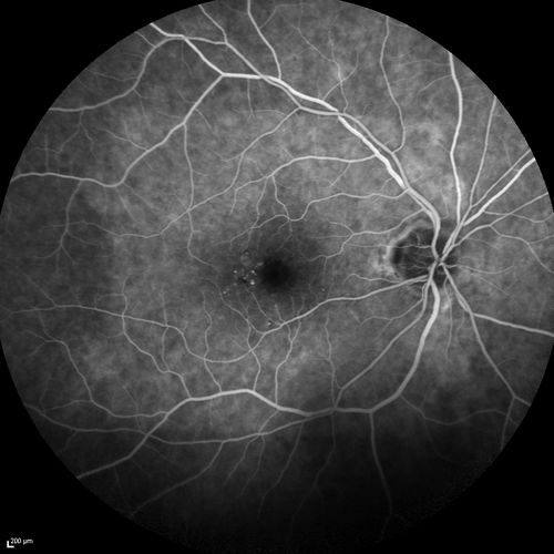 Microaneursyms and Macular Edema Not Diabetic
85 year old man has been tested about 2-3 times and is always negative for diabetes
