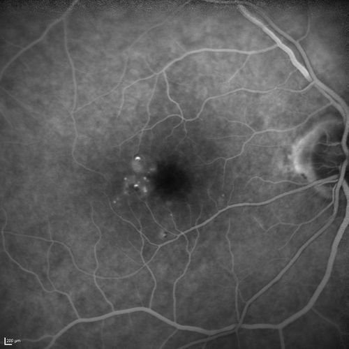 Microaneursyms and Macular Edema Not Diabetic
85 year old man has been tested about 2-3 times and is always negative for diabetes
