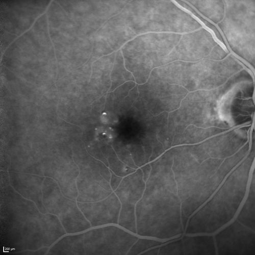 Microaneursyms and Macular Edema Not Diabetic
85 year old man has been tested about 2-3 times and is always negative for diabetes
