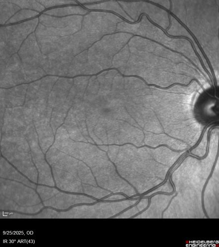 27 year old with migraine - normal imaging
