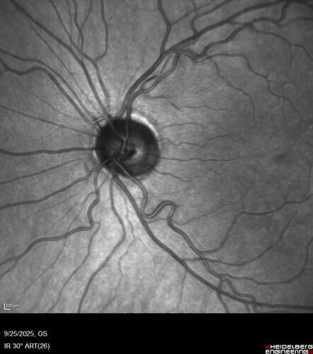 27 year old with migraine - normal imaging
